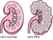 PKD image